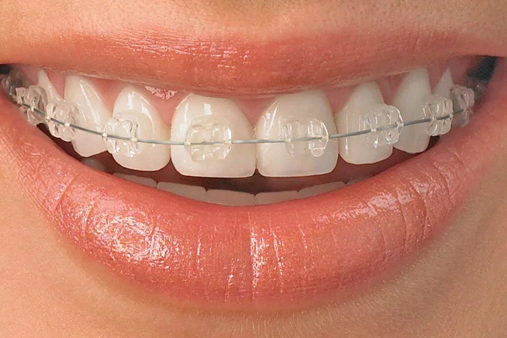 Make Your Teeth Look Attractive With Metal Braces!