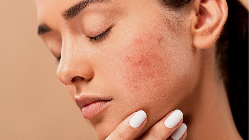 Various Methods For Treating Acne